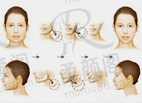 2025年上海仁爱医院馒化脸修复咋样？吸脂、整形医生靠谱，费用合理效果好