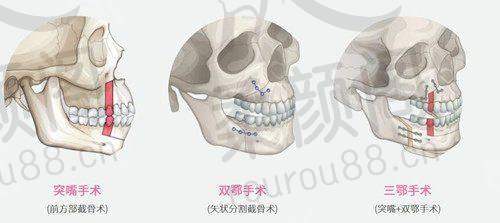 王刚刚医生拉皮手术详情
